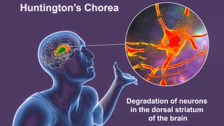 A picture showing a figure of a person on the left with his left hand raised. The line points from the brain to the pop-out bubble showing damaged neurons. Below the bubble is a text that reads "Degeneration of neurons in the dorsal striatum of the brain." Above the image is a caption that reads "Huntington's chorea."